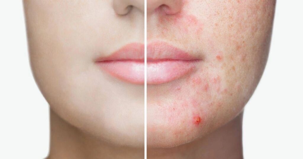 kozmetika proti akné